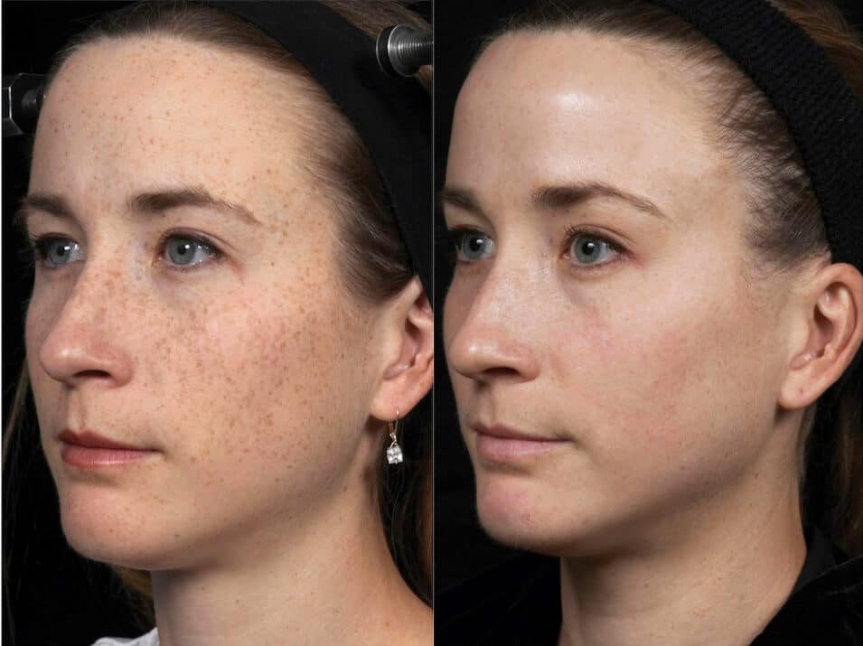 Before and After result H